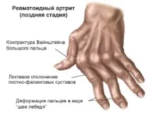 Артрит у медицині захворювання
