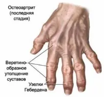 Артрит у медицині суглобах