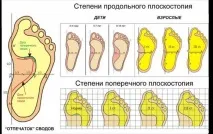 Плоскостопість - причини, симптоми та лікування симптоми