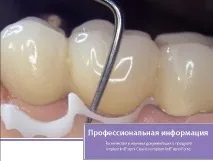 Dental-Revue, Статті, Ортопедична, Тимчасова фіксація тривалої дії на полімерній основі ортопедична