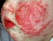 Дерматит атопічний причини, симптоми, лікування та ускладнення лікування