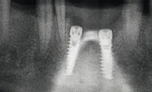 Імплантація при втраті нижніх різців - Dental Magazine нижніх
