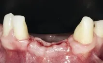 Імплантація при втраті нижніх різців - Dental Magazine імплантація