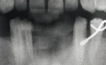 Імплантація при втраті нижніх різців - Dental Magazine втраті