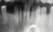 Імплантація при втраті нижніх різців - Dental Magazine втраті