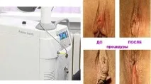 Інтимне омолодження на апараті Фотона інтимне