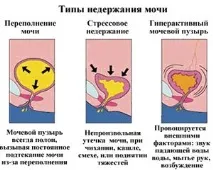 Інтимне омолодження на апараті Фотона омолодження