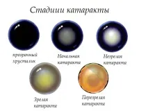 катаракта
