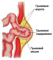Лікування грижі у немовлят хірург або знахарка. немовлят