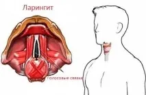 Ларингіт симптоми та лікування у дорослих людей, типи захворювань лікування
