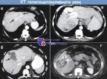 Лікування та прогноз раку печінки лікування