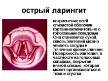 Ларингіт симптоми та лікування у дорослих людей, типи захворювань ларингіт