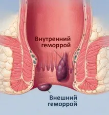 Лікування геморою в СПб (Виборський район) - ціни лікування геморою в клініці, Медичний центр район