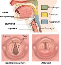 Ларингіт симптоми та лікування у дорослих людей, типи захворювань симптоми