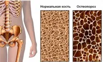 Мармурова хвороба у дітей (фото) хвороба