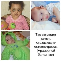 Мармурова хвороба у дітей (фото) хвороба