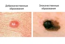 атипові