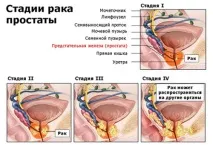 біопсія