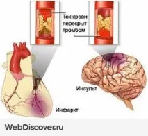 ШВИДКЕ ПОРЯТУВАННЯ ВІД ІНСУЛЬТУ! швидке
