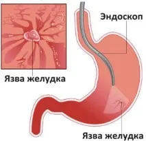 симптоми