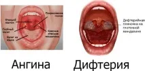 дифтерія