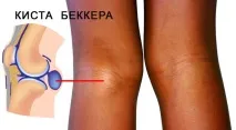 Кіста Бейкера причини, ознаки, діагностика та лікування діагностика