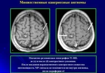 Tratamentul angiomului cavernos al creierului, prognostic