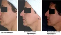 Термаж що це, на якому апараті проводиться, ціни та відгуки проводиться