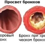 Мокрота в бронхах як вивести народними засобами. бронхах
