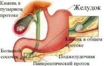 Пронос після видалення жовчного міхура, що робити пронос