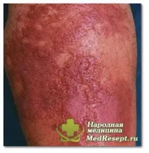 Рожеве запалення ноги – зволікання неприпустимо неприпустимо