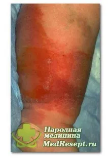 Рожеве запалення ноги – зволікання неприпустимо рожеве