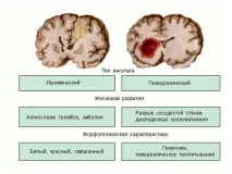 Симптоми інсульту у жінок (перші ознаки) інсульту