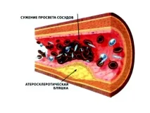 Симптоми інсульту у жінок (перші ознаки) симптоми