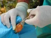 Видалення грибка нігтів видалення