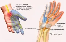 Тунельний синдром операція процедура та анестезія може