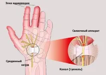 карпалния