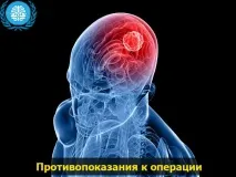 Видалення пухлини головного мозку пухлини