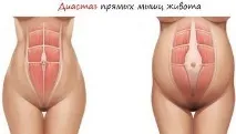 Живіт як у вагітної - Модна красива модна