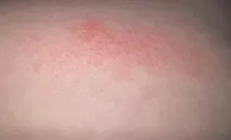 симптоми