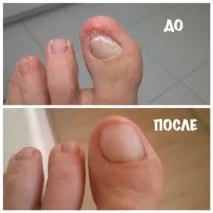 Білі плями на нігтях пальців рук нігтях