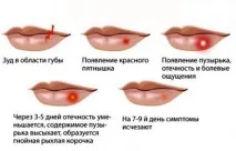 лікування