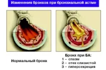 астма