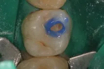 bulk-fill