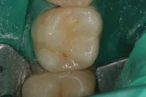 bulk-fill