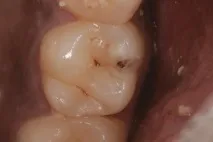 bulk-fill