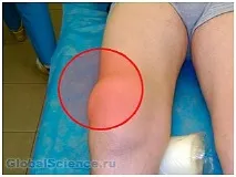 Лікарі стурбовані збільшенням випадків захворювання - гігрома колінного суглоба захворювання