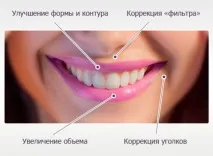 Juvederm Ultra 3 (Ювідерм ультра 3) - що це таке, ціни, відгуки, фото juvederm