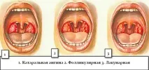 Катаральна форма ангіни симптоми та лікування катаральна
