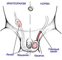 КРИПТОРХІЗМ – ЛІКУВАННЯ залози